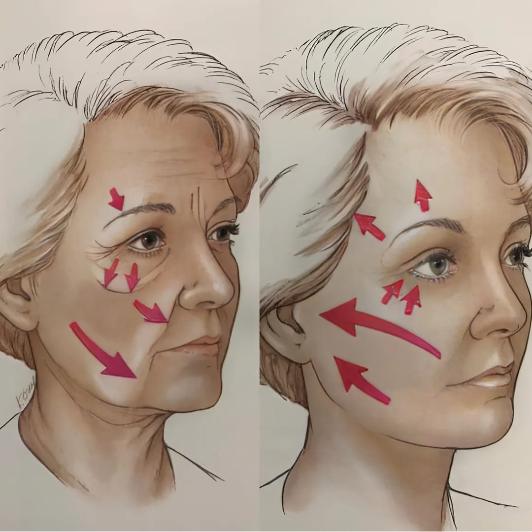 Cirugía Facial Lifting