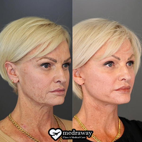 Face Lift Dutch