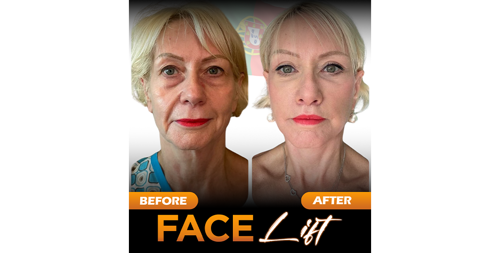 Facelift