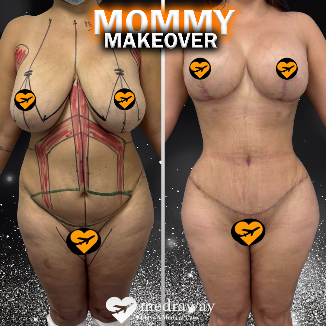 360 Liposuction