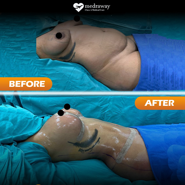 Tummy Tuck 