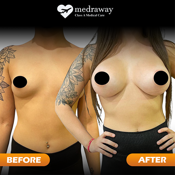 Breast Implant