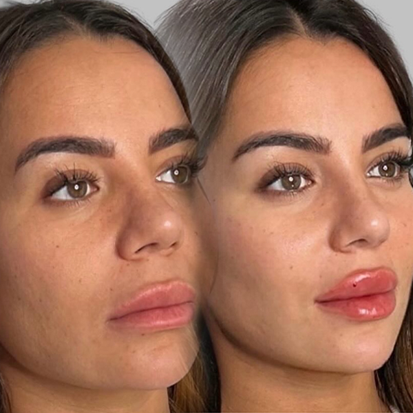 Lip Lift 
