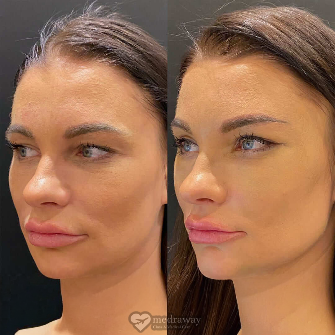 Cat eye surgery