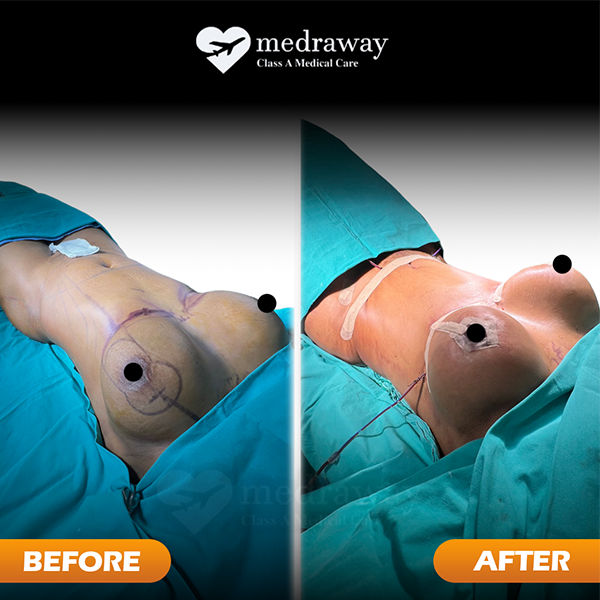 Breast Lifting (Mastopexy)