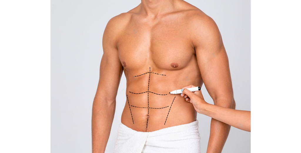 Abdominal Etching