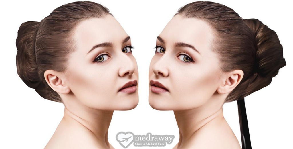 Rhinoplasty