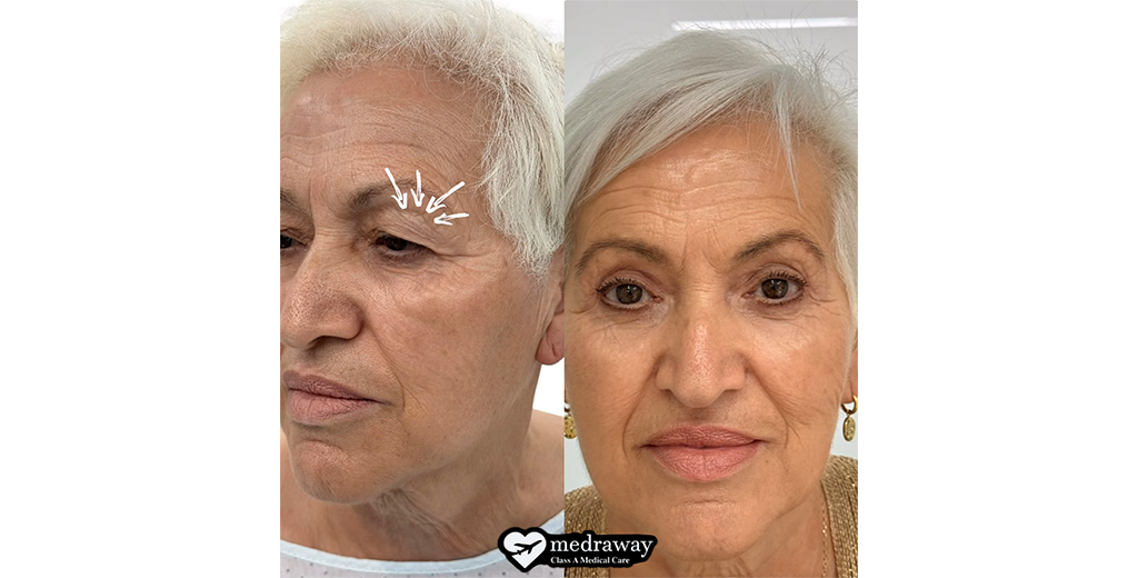 Blepharoplasty