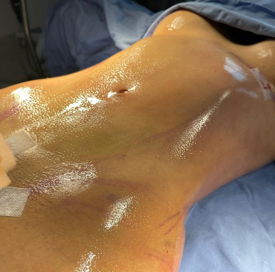 Vaser Liposuction